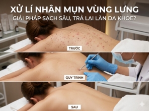 Xử Lí Nhân Mụn Vùng Lưng